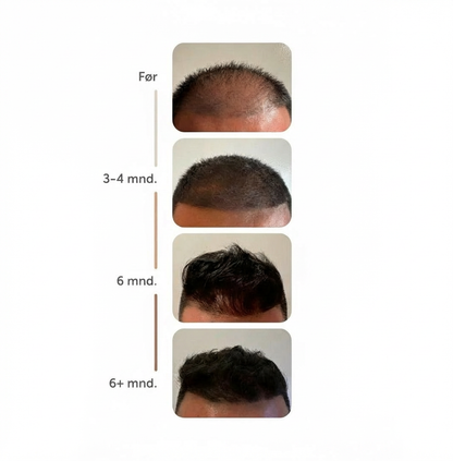 Minoxidil 5 % + Biotin Spray – 12 måneders forbruk